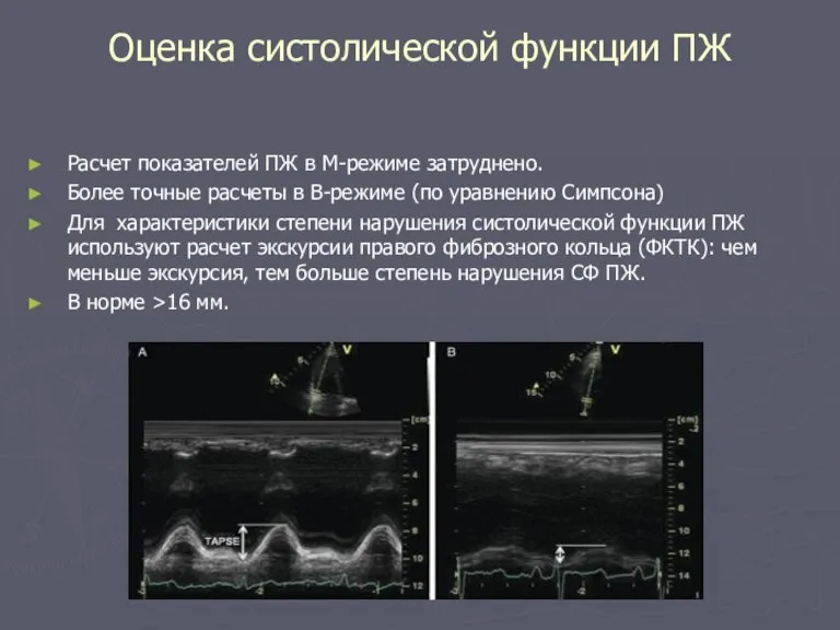 Оценка систолической функции ПЖ Расчет показателей ПЖ в М-режиме затруднено.