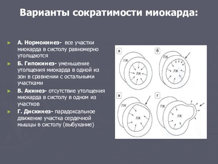 Варианты сократимости миокарда: А. Нормокинез- все участки миокарда в систолу