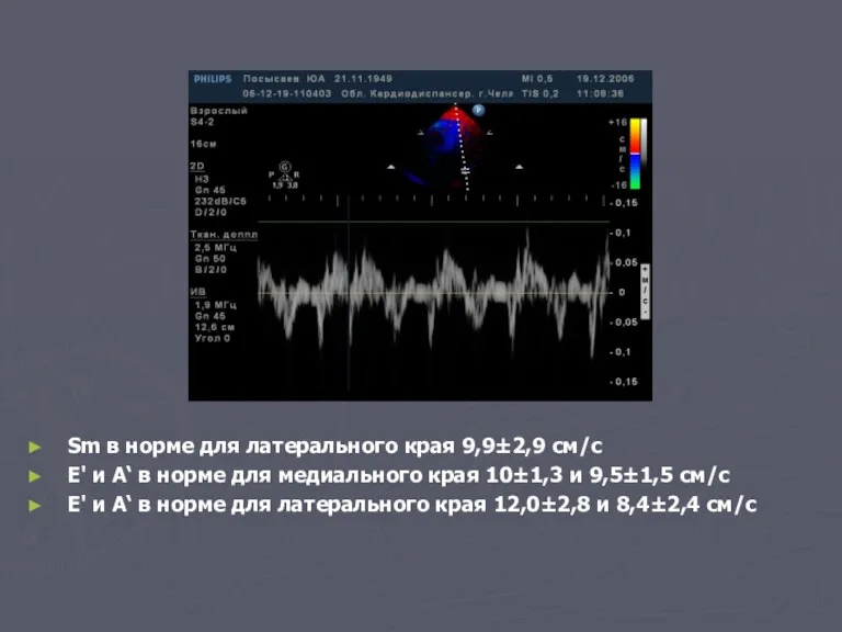 Sm в норме для латерального края 9,9±2,9 см/с E' и