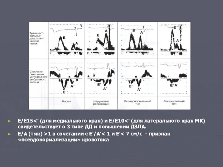 Е/Е׳>15 (для медиального края) и Е/Е׳>10 (для латерального края МК)