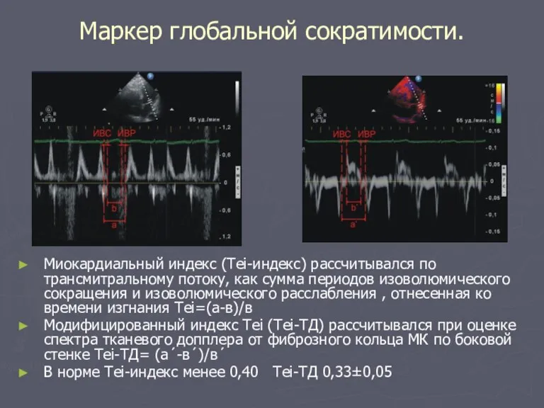 Маркер глобальной сократимости. Миокардиальный индекс (Tei-индекс) рассчитывался по трансмитральному потоку,