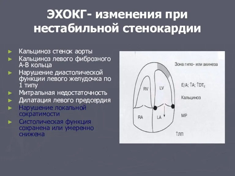 ЭХОКГ- изменения при нестабильной стенокардии Кальциноз стенок аорты Кальциноз левого