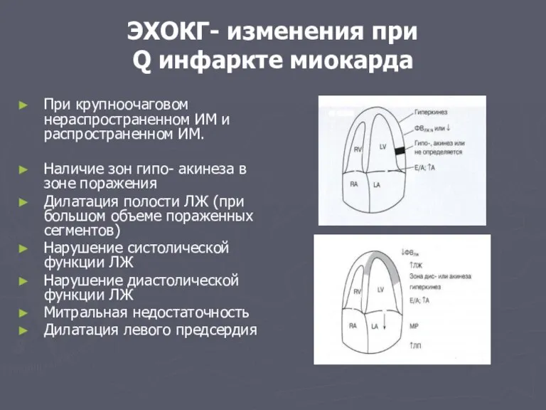 ЭХОКГ- изменения при Q инфаркте миокарда При крупноочаговом нераспространенном ИМ