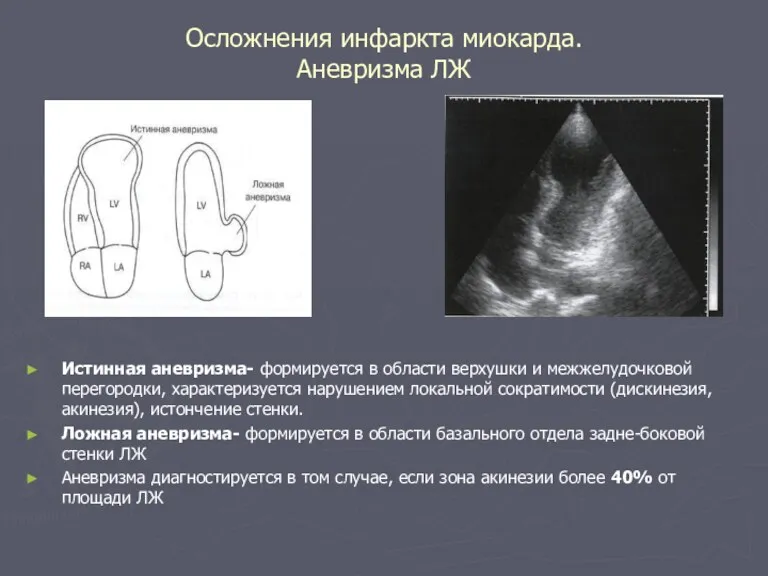 Осложнения инфаркта миокарда. Аневризма ЛЖ Истинная аневризма- формируется в области