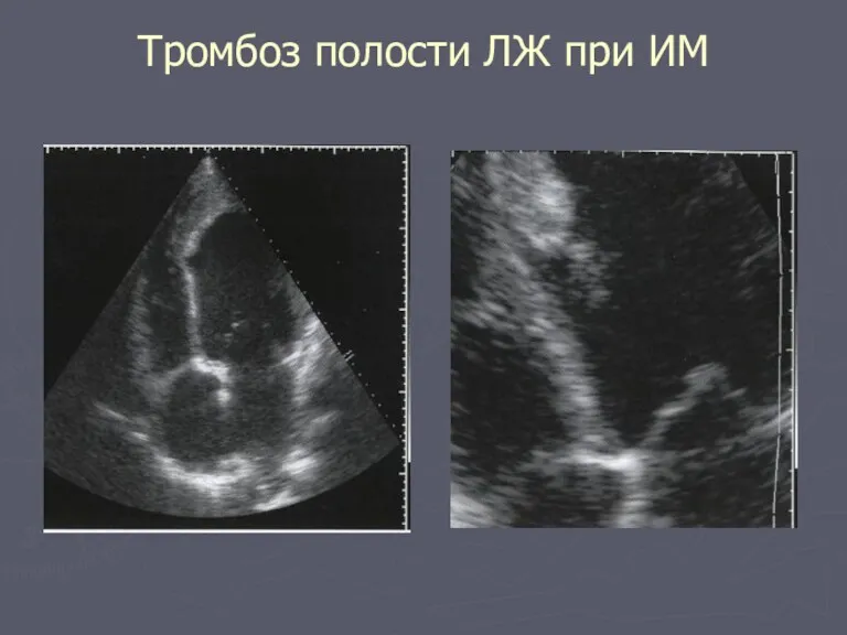 Тромбоз полости ЛЖ при ИМ