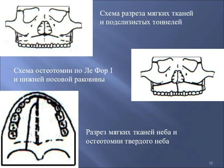 Схема разреза мягких тканей и подслизистых тоннелей Разрез мягких тканей