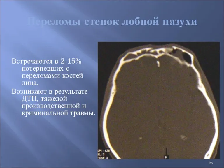 Переломы стенок лобной пазухи Встречаются в 2-15% потерпевших с переломами