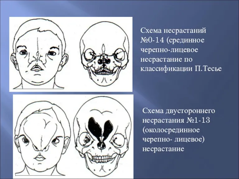 Схема несрастаний №0-14 (срединное черепно-лицевое несрастание по классификации П.Тесье Схема