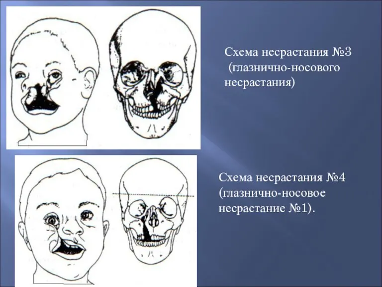 Схема несрастания №3 (глазнично-носового несрастания) Схема несрастания №4 (глазнично-носовое несрастание №1).