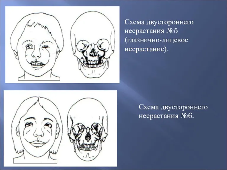 Схема двустороннего несрастания №5 (глазнично-лицевое несрастание). Схема двустороннего несрастания №6.