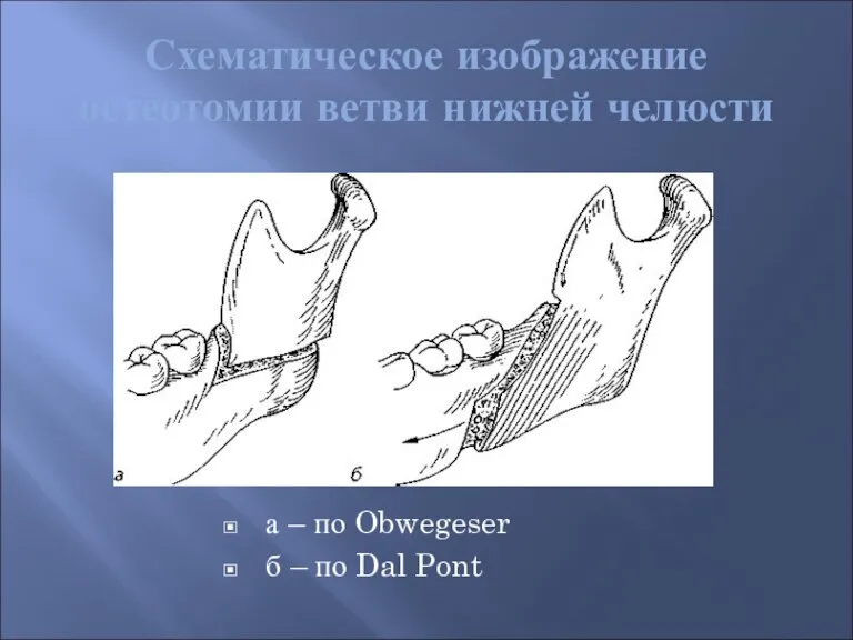 Схематическое изображение остеотомии ветви нижней челюсти а – по Obwegeser б – по Dal Pont