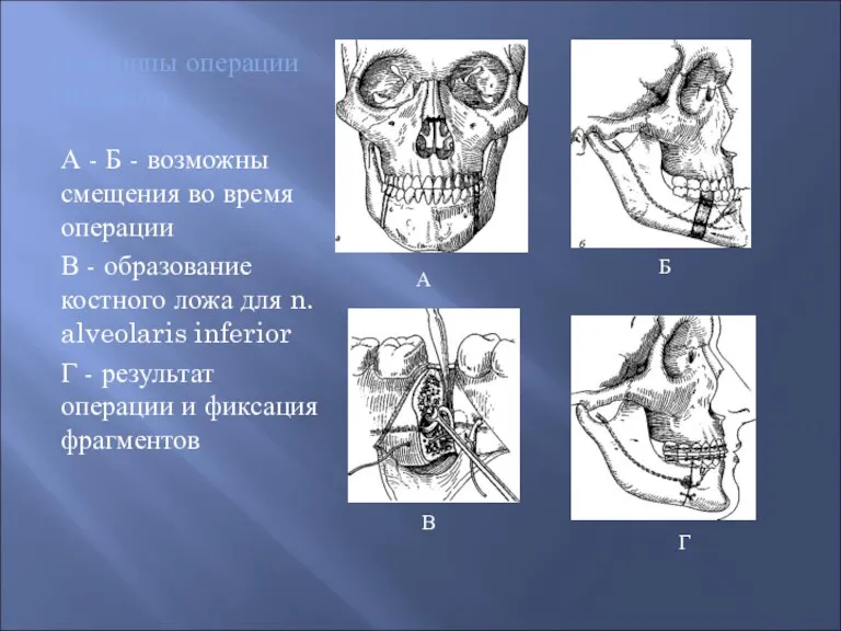 Принципы операции Dingman А - Б - возможны смещения во