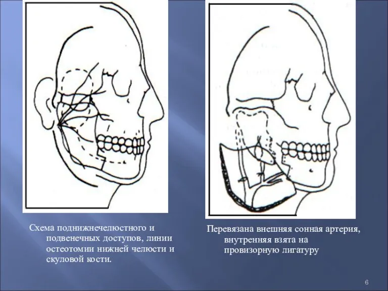 Схема поднижнечелюстного и подвенечных доступов, линии остеотомии нижней челюсти и