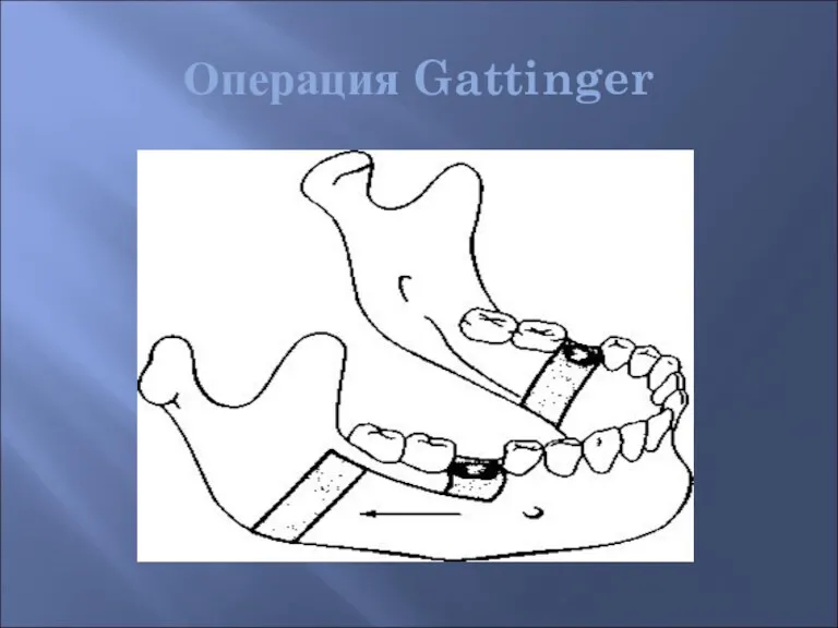 Операция Gattinger