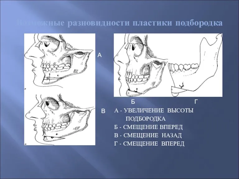 Возможные разновидности пластики подбородка А - УВЕЛИЧЕНИЕ ВЫСОТЫ ПОДБОРОДКА Б