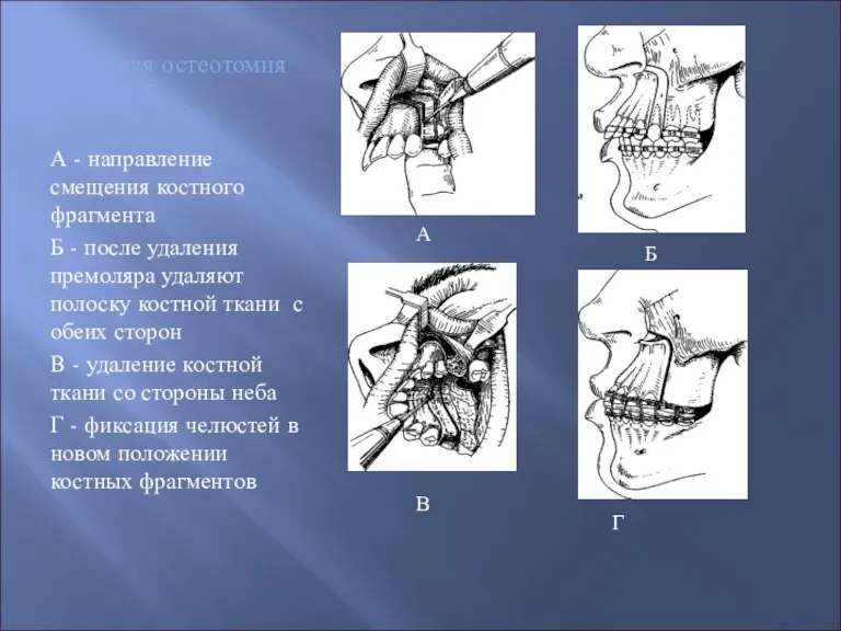 Передняя остеотомия по KOLE А - направление смещения костного фрагмента