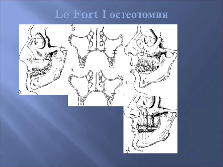 Le Fort І остеотомия А Б В Г Д Le Fort I