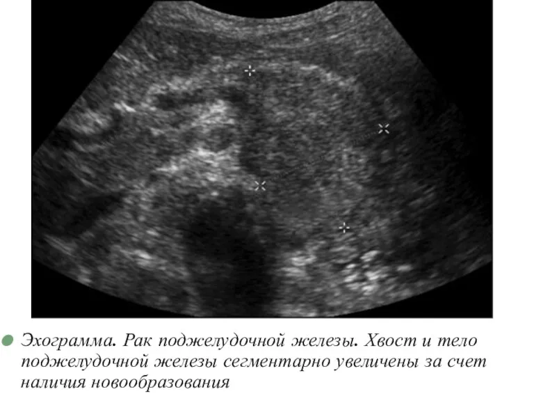 Эхограмма. Рак поджелудочной железы. Хвост и тело поджелудочной железы сегментарно увеличены за счет наличия новообразования