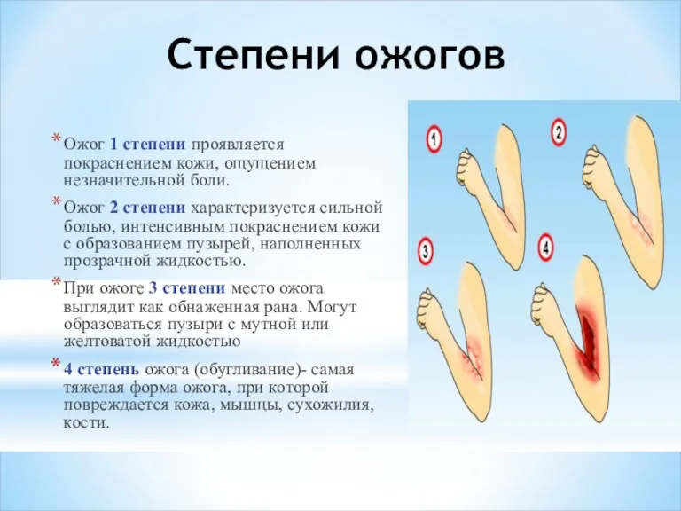 Степени ожогов Ожог 1 степени проявляется покраснением кожи, ощущением незначительной