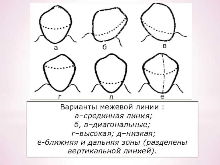 Варианты межевой линии : а–срединная линия; б, в–диагональные; г–высокая; д–низкая;