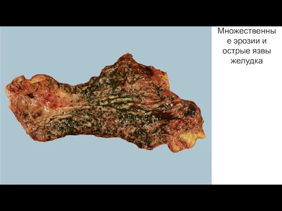 Множественные эрозии и острые язвы желудка