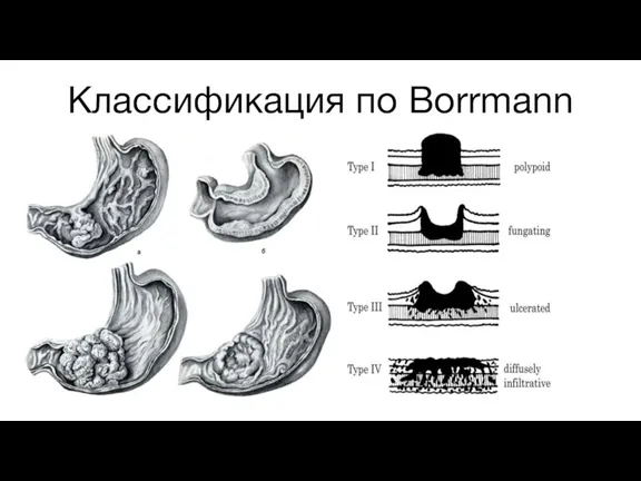 Классификация по Borrmann