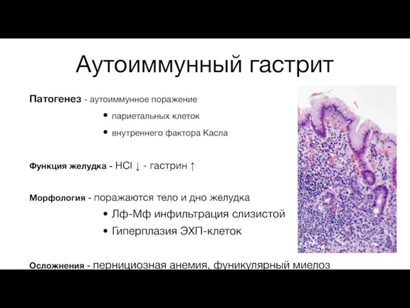 Аутоиммунный гастрит Патогенез - аутоиммунное поражение париетальных клеток внутреннего фактора