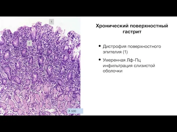 Х 100 Дистрофия поверхностного эпителия (1) Умеренная Лф-Пц инфильтрация слизистой оболочки 1 2 Хронический поверхностный гастрит