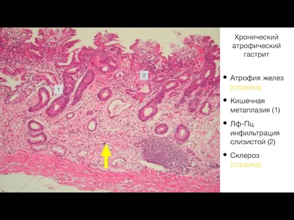 Хронический атрофический гастрит Атрофия желез (стрелка) Кишечная метаплазия (1) Лф-Пц