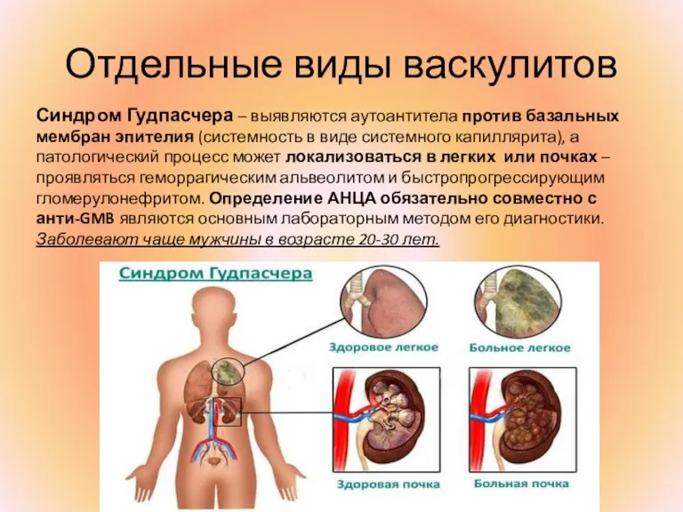 Отдельные виды васкулитов Синдром Гудпасчера – выявляются аутоантитела против базальных