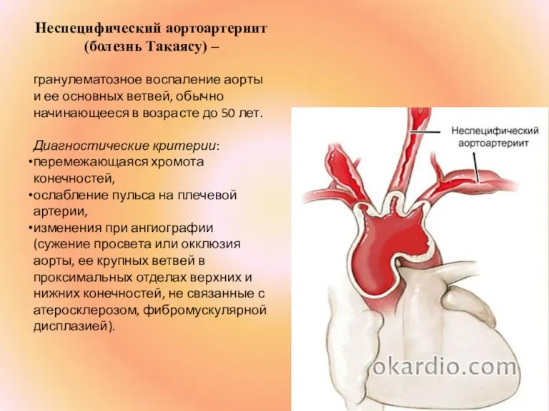 Неспецифический аортоартериит (болезнь Такаясу) – гранулематозное воспаление аорты и ее