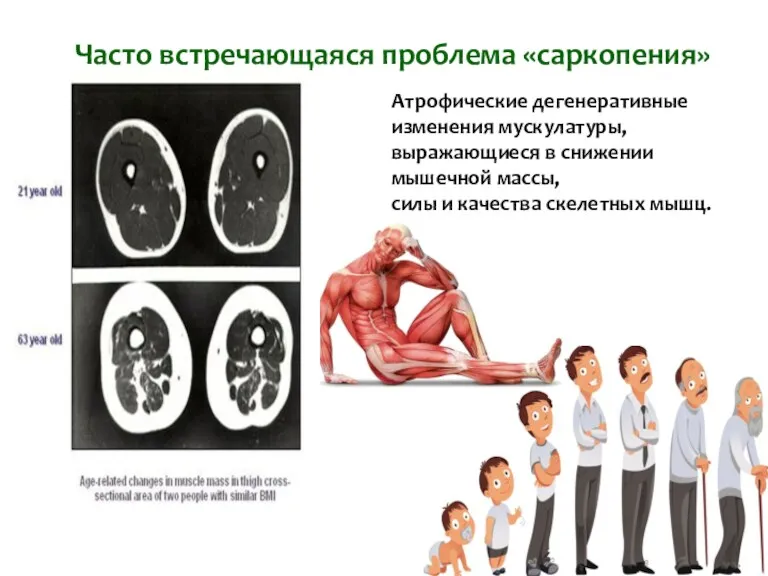 Часто встречающаяся проблема «саркопения» Атрофические дегенеративные изменения мускулатуры, выражающиеся в