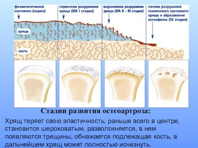 Стадии развития остеоартроза: Хрящ теряет свою эластичность, раньше всего в