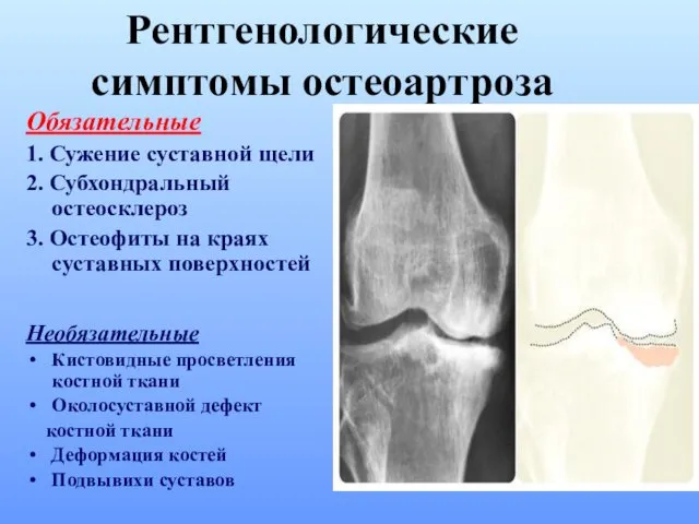 Обязательные 1. Сужение суставной щели 2. Субхондральный остеосклероз 3. Остеофиты