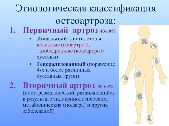 Этиологическая классификация остеоартроза: Первичный артроз 40-50% Локальный (кисти, стопы, коленные (гонартроз), тазобедренные (коксартроз)
