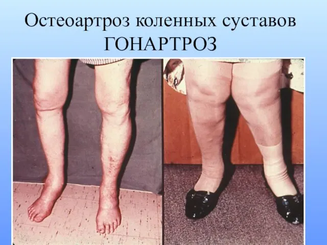 Остеоартроз коленных суставов ГОНАРТРОЗ
