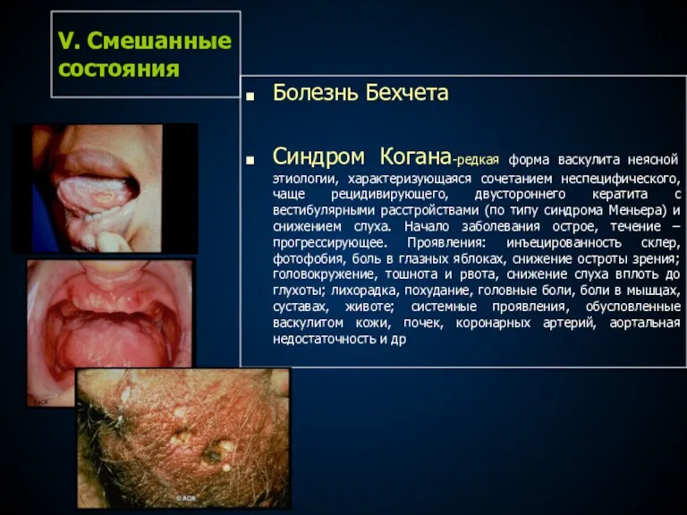 V. Cмешанные состояния Болезнь Бехчета Синдром Когана-редкая форма васкулита неясной