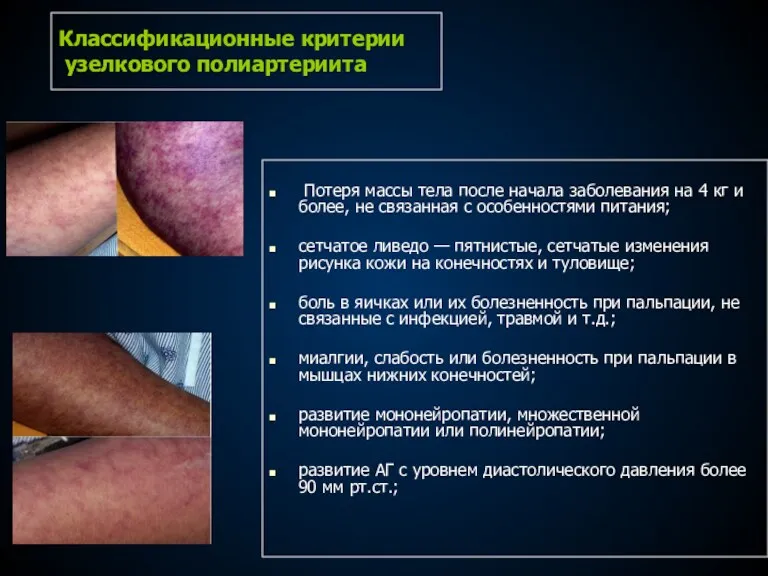 Классификационные критерии узелкового полиартериита Потеря массы тела после начала заболевания