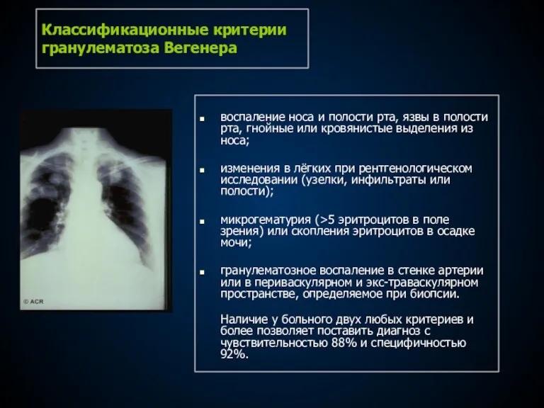 Классификационные критерии гранулематоза Вегенера воспаление носа и полости рта, язвы