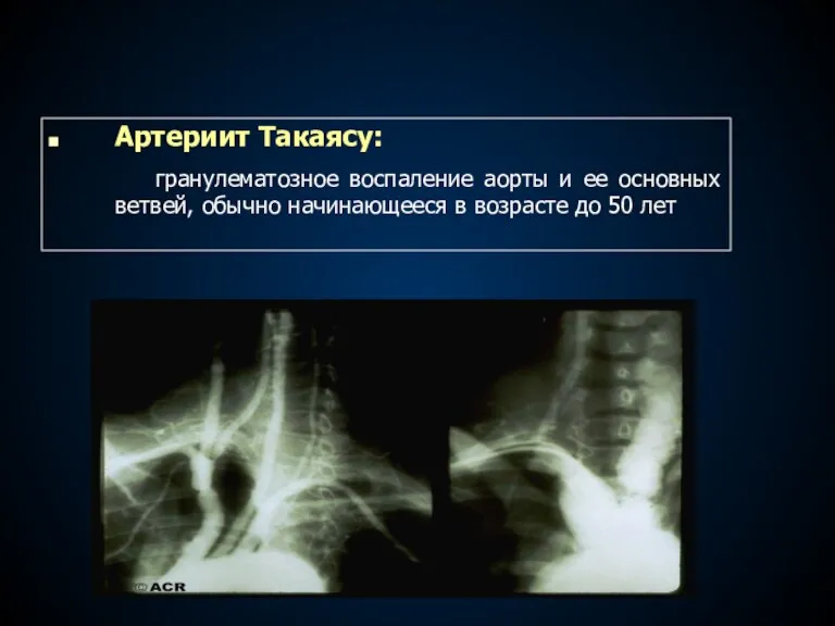 Артериит Такаясу: гранулематозное воспаление аорты и ее основных ветвей, обычно начинающееся в возрасте до 50 лет