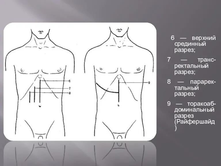 6 — верхний срединный разрез; 7 — транс-ректальный разрез; 8