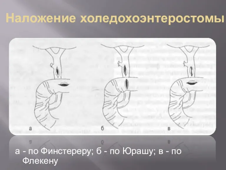 Наложение холедохоэнтеростомы а - по Финстереру; б - по Юрашу; в - по Флекену