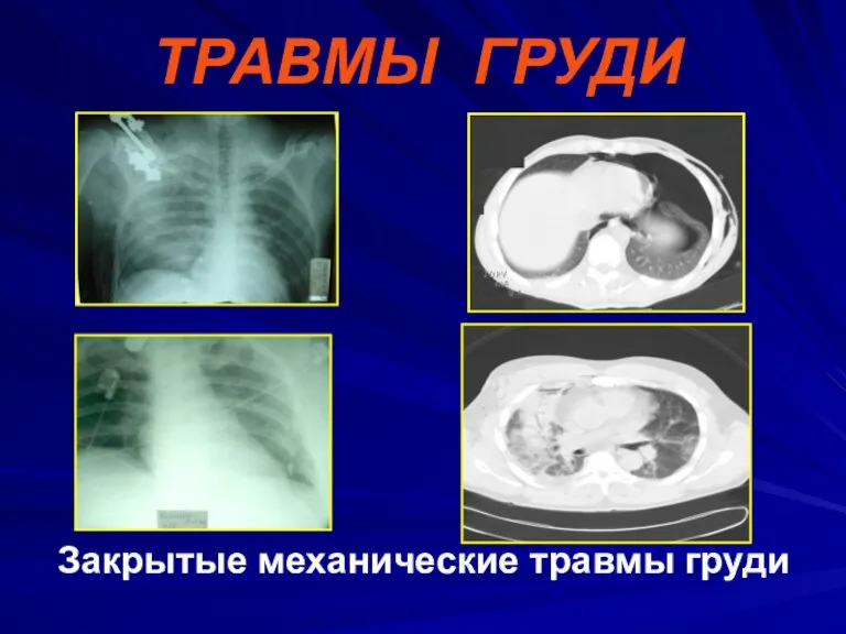 ТРАВМЫ ГРУДИ Закрытые механические травмы груди