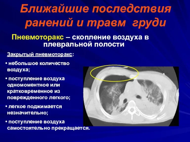 Ближайшие последствия ранений и травм груди Пневмоторакс – скопление воздуха