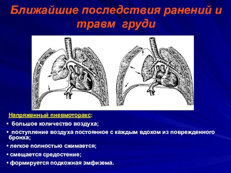 Ближайшие последствия ранений и травм груди Напряженный пневмоторакс: большое количество