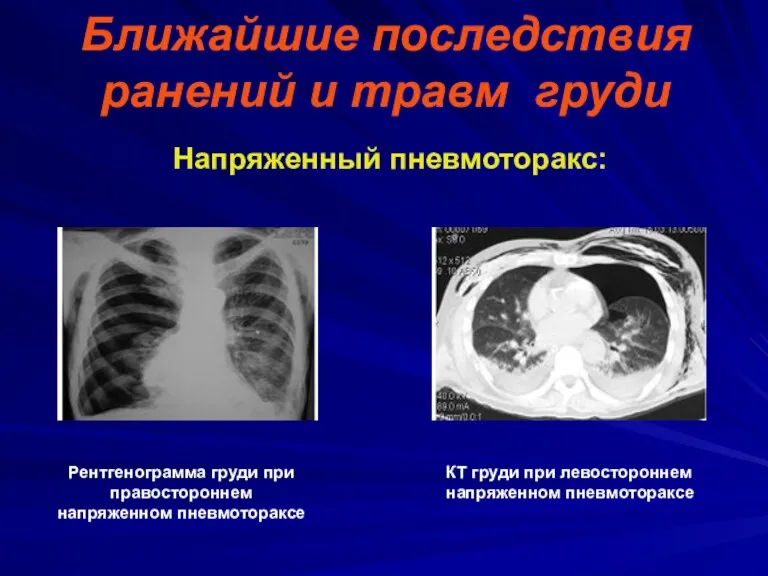 Ближайшие последствия ранений и травм груди Напряженный пневмоторакс: Рентгенограмма груди