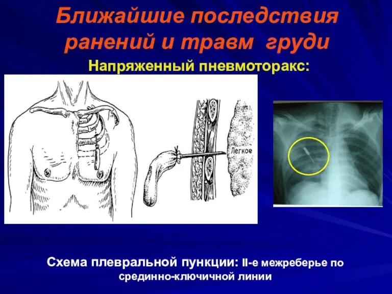 Ближайшие последствия ранений и травм груди Напряженный пневмоторакс: Схема плевральной пункции: II-е межреберье по срединно-ключичной линии