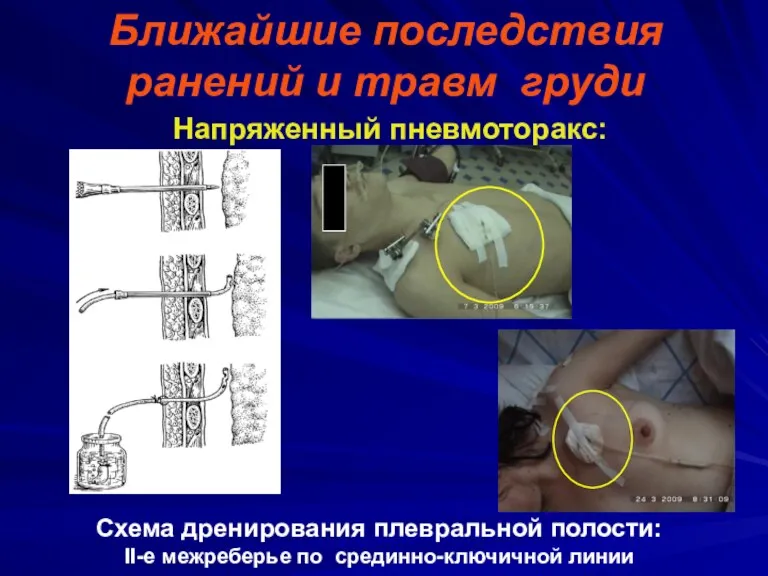 Ближайшие последствия ранений и травм груди Напряженный пневмоторакс: Схема дренирования