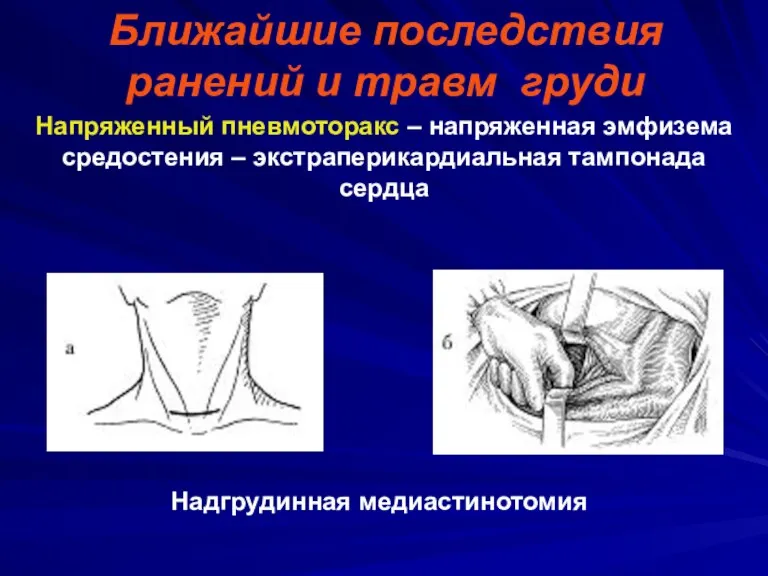 Ближайшие последствия ранений и травм груди Напряженный пневмоторакс – напряженная