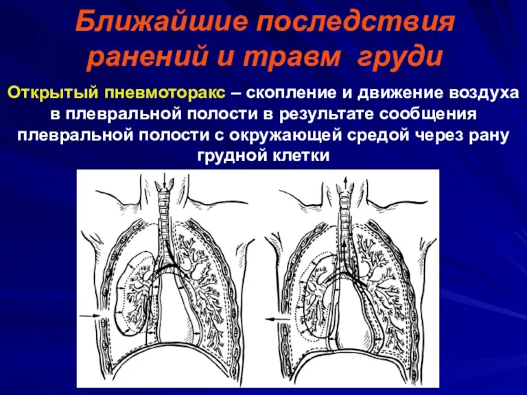 Ближайшие последствия ранений и травм груди Открытый пневмоторакс – скопление